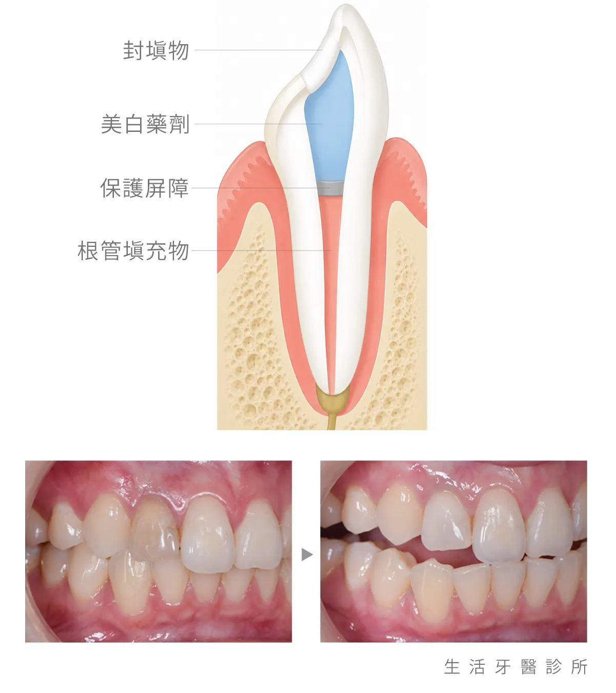 台中南投生活牙醫根管治療後變色牙齒內美白示意
